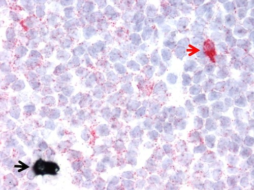 B-cell lymphoma 