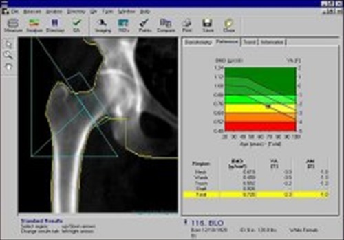 Bone Mineral Densitometry DEXA