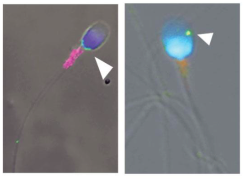 Spermatozoa infected by Zika virus