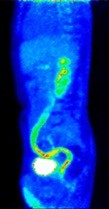 18F-FDG PET. Imaging inflammatory bowel disease (IBD) - whole body molecular imaging is available but current molecular probes like 18F-fluorodeoxyglucose (18F-FDG) lack cellular specificity.